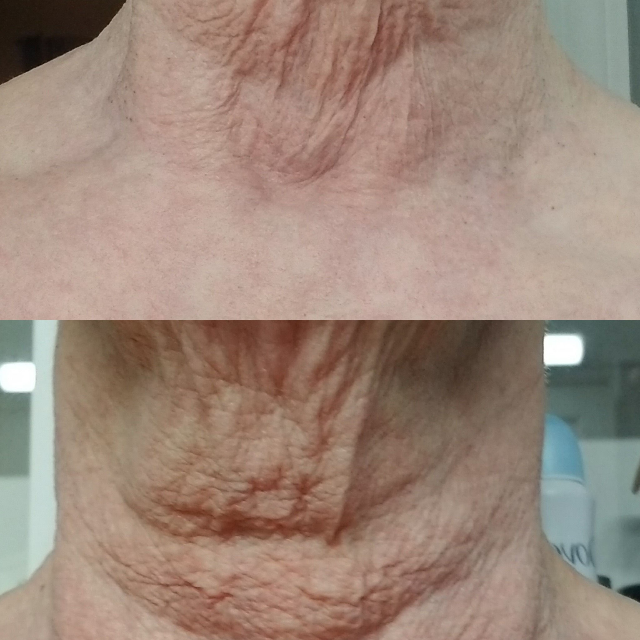fibroblast neck